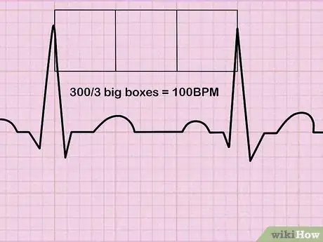 Image titled Read an EKG Step 6