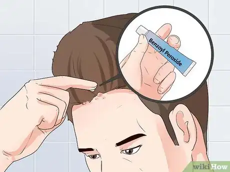 Image titled Treat Scalp Pimples Step 7