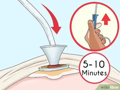 Image titled Irrigate Your Colostomy Step 10