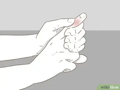 Image titled Determine if a Finger Is Broken Step 14