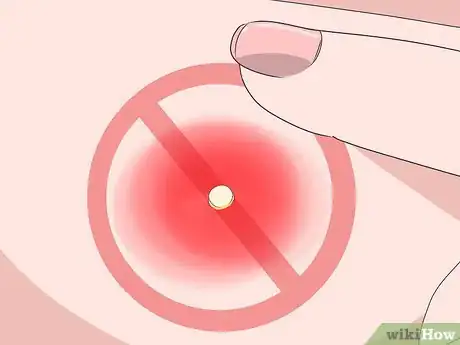 Image titled Remove Pus from a Wound Step 11