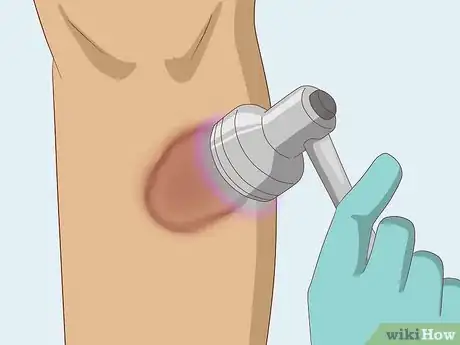Image titled Naturally Stop Granuloma Annulare Step 8