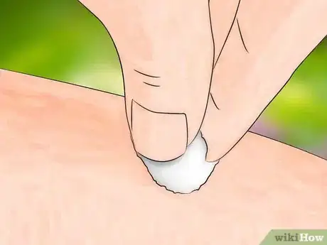 Image titled Get Bug Bites to Stop Itching Step 16