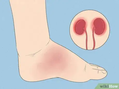 Image titled Treat Swollen Ankles and Feet for Lupus Nephritis Step 11