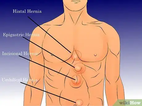 Image titled Check for a Hernia Step 1