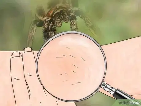 Image titled Identify a Spider Bite Step 3