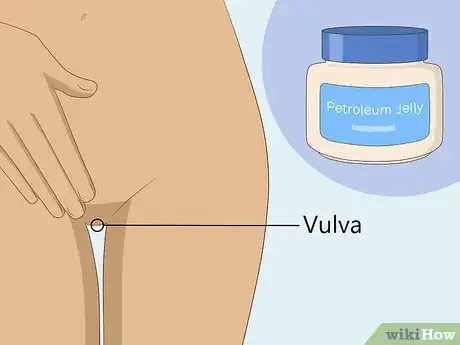 Image titled Get Rid of a Yeast Infection at Home Step 11