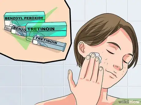 Image titled Use Tretinoin and Benzoyl Peroxide Concurrently Step 2