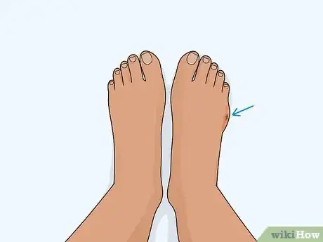 Image titled Heal a Toe Injury Step 1