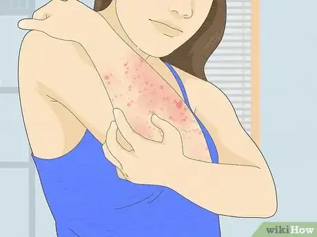 Image titled Heal Armpit Rash Step 4