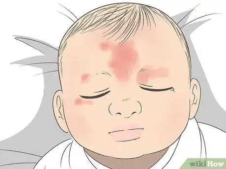 Image titled Know What to Expect on a Newborn's Skin Step 2