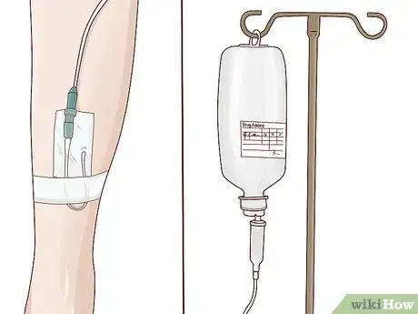 Image titled Treat Rhabdomyolysis Step 5