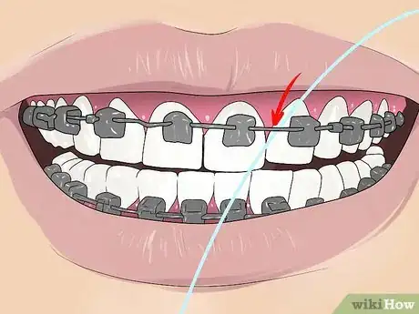 Image titled Floss With Braces Step 2