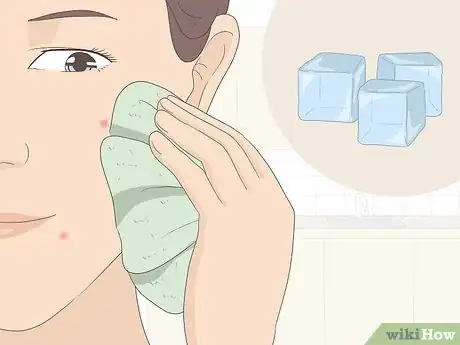 Image titled Get Rid of Acne Redness Fast Step 1