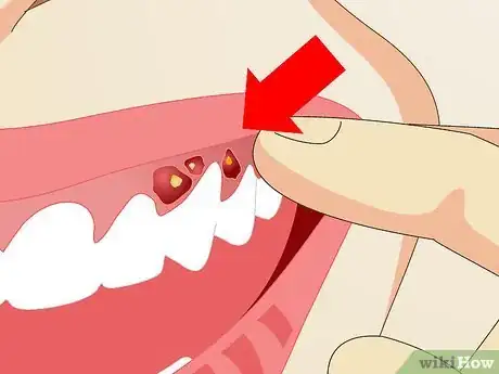Image titled Remove Bad Breath Step 15