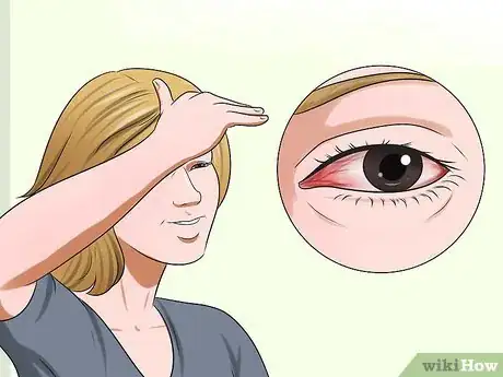Image titled Treat Pink Eye (Conjunctivitis) Step 1