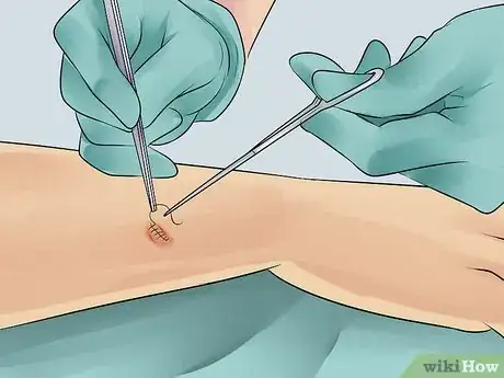 Image titled Heal from a Skin Biopsy Step 10