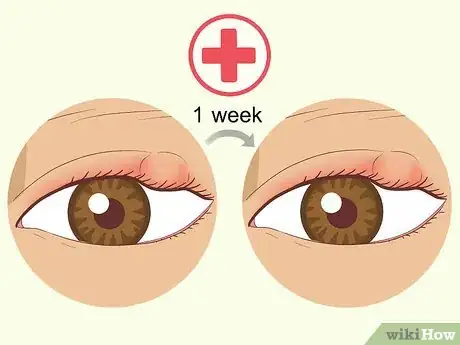 Image titled Get Rid of Puffy Eyelids Step 12