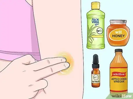 Image titled Get Rid of a Scab Step 10