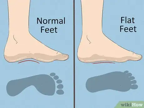 Image titled Fix Flat Feet Step 1