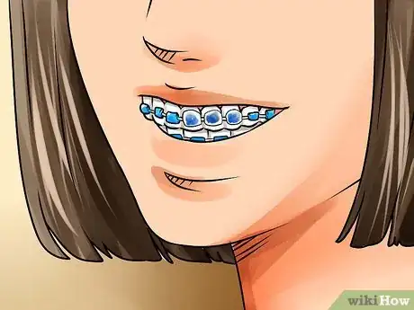 Image titled Apply Dental Wax on Braces Step 9