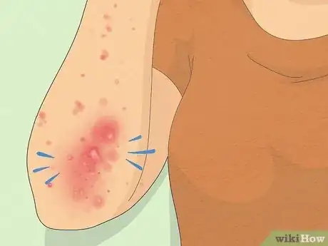 Image titled Recognize Scabies Rash Step 3