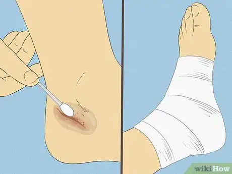 Image titled Treat a Broken Ankle Step 6