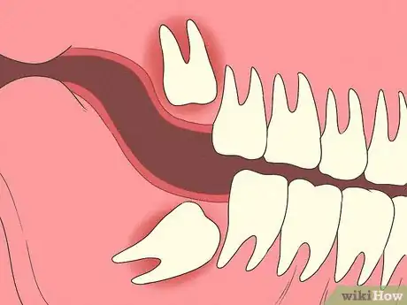 Image titled Tell Between an Erupting and Impacted Wisdom Tooth Step 6