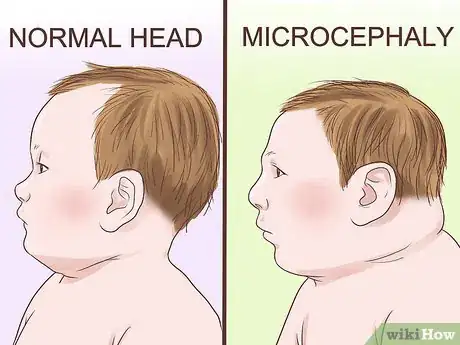 Image titled Recognize and Treat Cytomegalovirus (CMV) Step 2