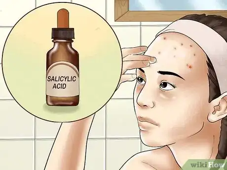 Image titled Get Rid of Forehead Acne Step 2