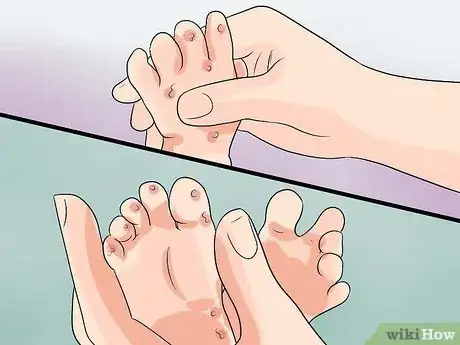 Image titled Recognize and Treat Hand, Foot, and Mouth Disease Step 3