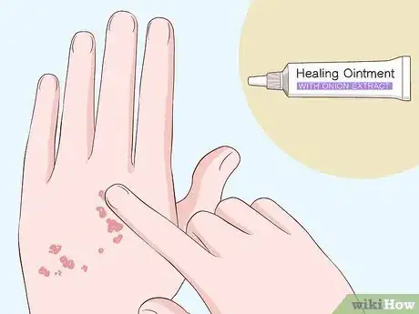 Image titled Heal Scabies Scars Step 2