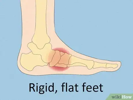 Image titled Fix Flat Feet Step 3