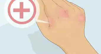 Heal Cracked Skin