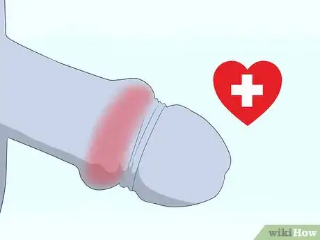 Image titled Pull Your Foreskin Back Without Pain Step 10