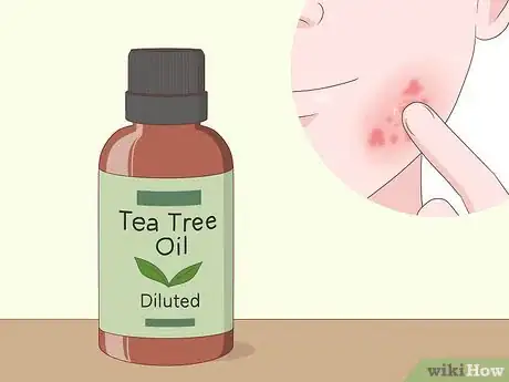 Image titled Treat a Skin Yeast Infection Naturally Step 1