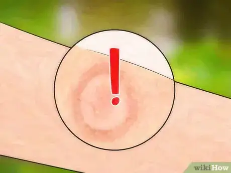 Image titled Get Bug Bites to Stop Itching Step 19