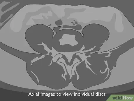 Image titled Read a Lumbar MRI Step 04