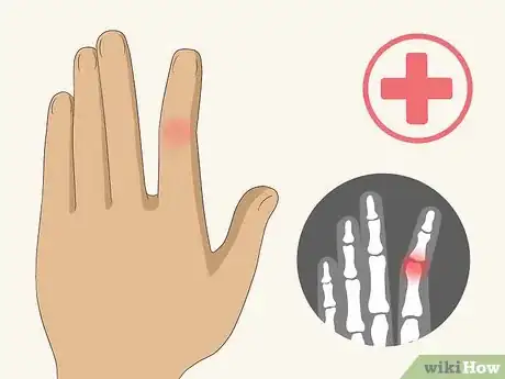 Image titled Remove a Ring in an Emergency Step 15