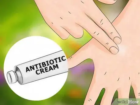 Image titled Get Bug Bites to Stop Itching Step 17