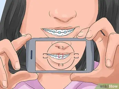 Image titled Prepare for Getting Braces Removed Step 4