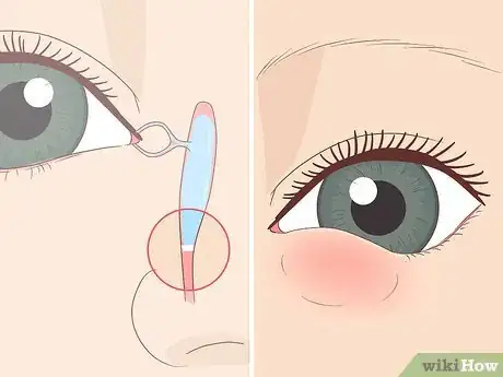 Image titled Clear a Blocked Tear Duct Step 1