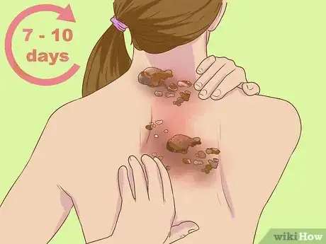 Image titled Recognize Shingles Symptoms (Herpes Zoster Symptoms) Step 6