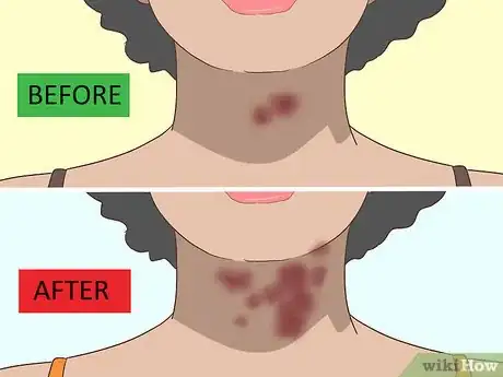 Image titled Treat a Rash on the Neck Step 5