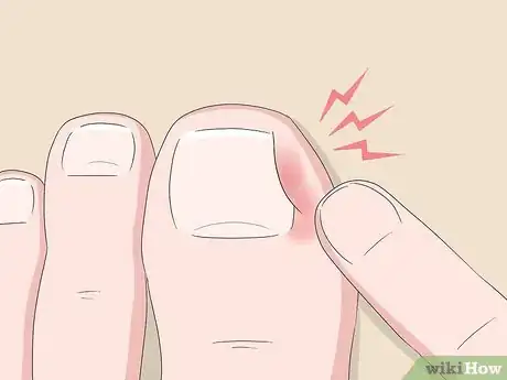 Image titled Relieve Ingrown Toe Nail Pain Step 2