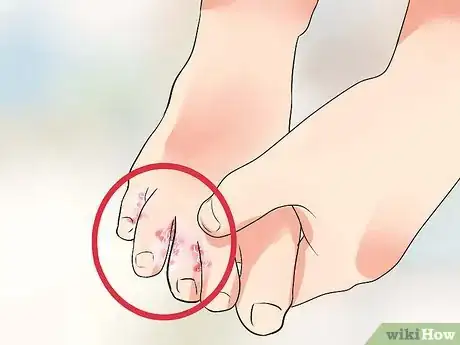Image titled Know if You Have Athlete's Foot Step 1