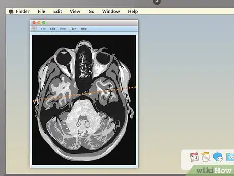 Image titled Read an MRI Step 10