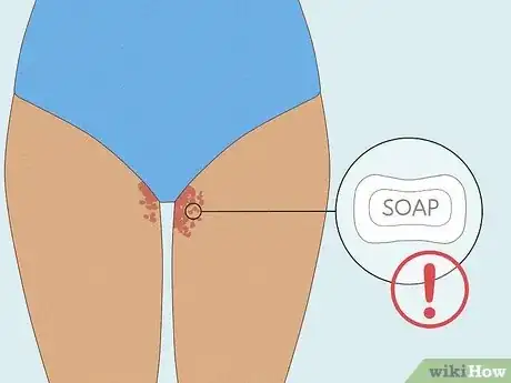 Image titled Get Rid of a Rash Between Your Legs Step 9