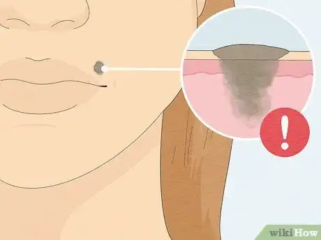 Image titled Remove a Mole with Iodine Step 2