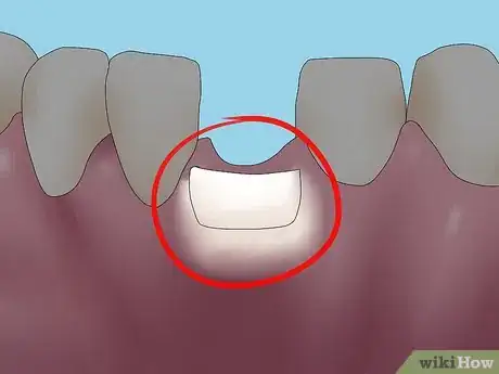 Image titled Reverse Dental Bone Loss Step 2